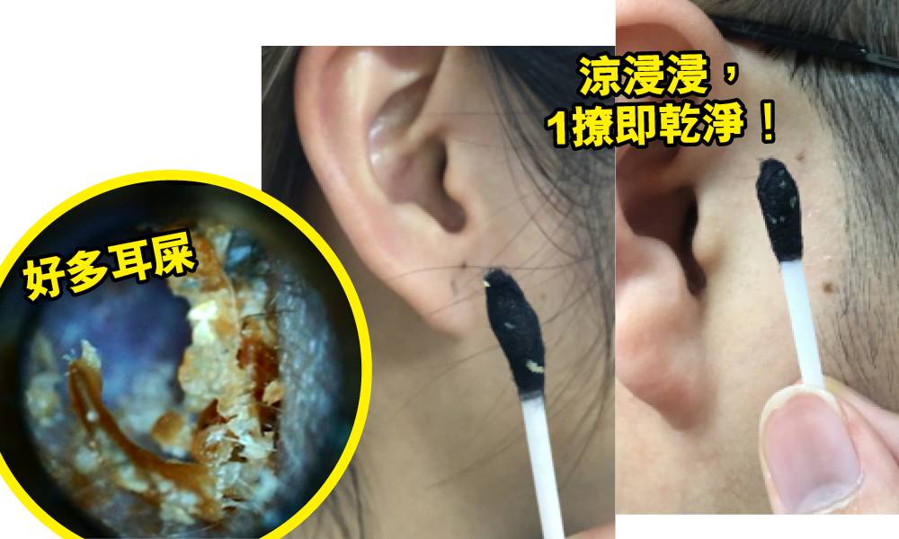 耳垢清潔