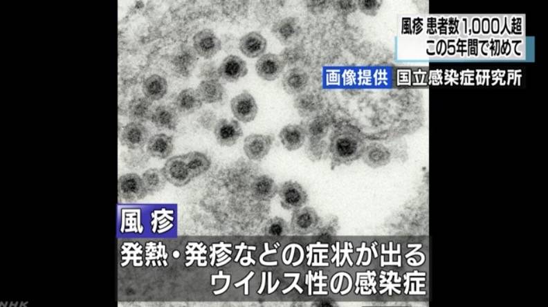 德國麻疹 德國痲疹潛伏期由12至23天不等，通常為期14天。｜圖：NHK news