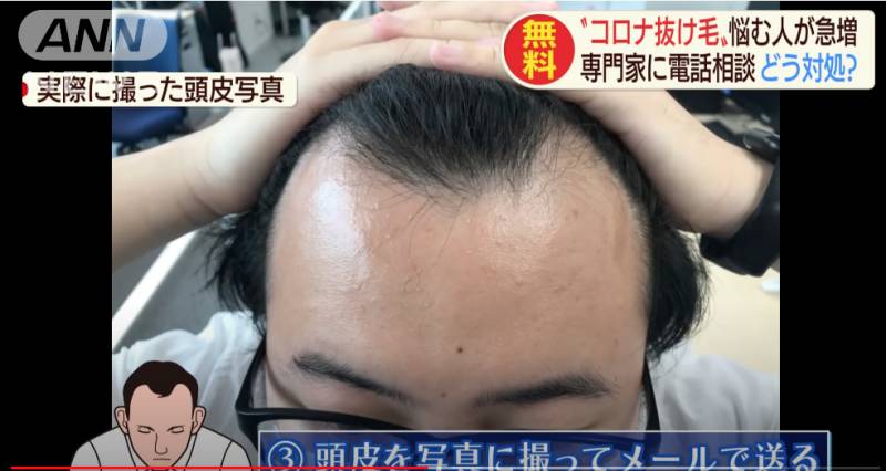 【新冠肺炎】日本新冠肺炎繼離婚潮 又一社會現象「新冠脫髮」
