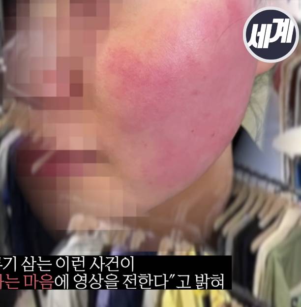 比利時駐韓大使 店員的臉部被打至紅腫。