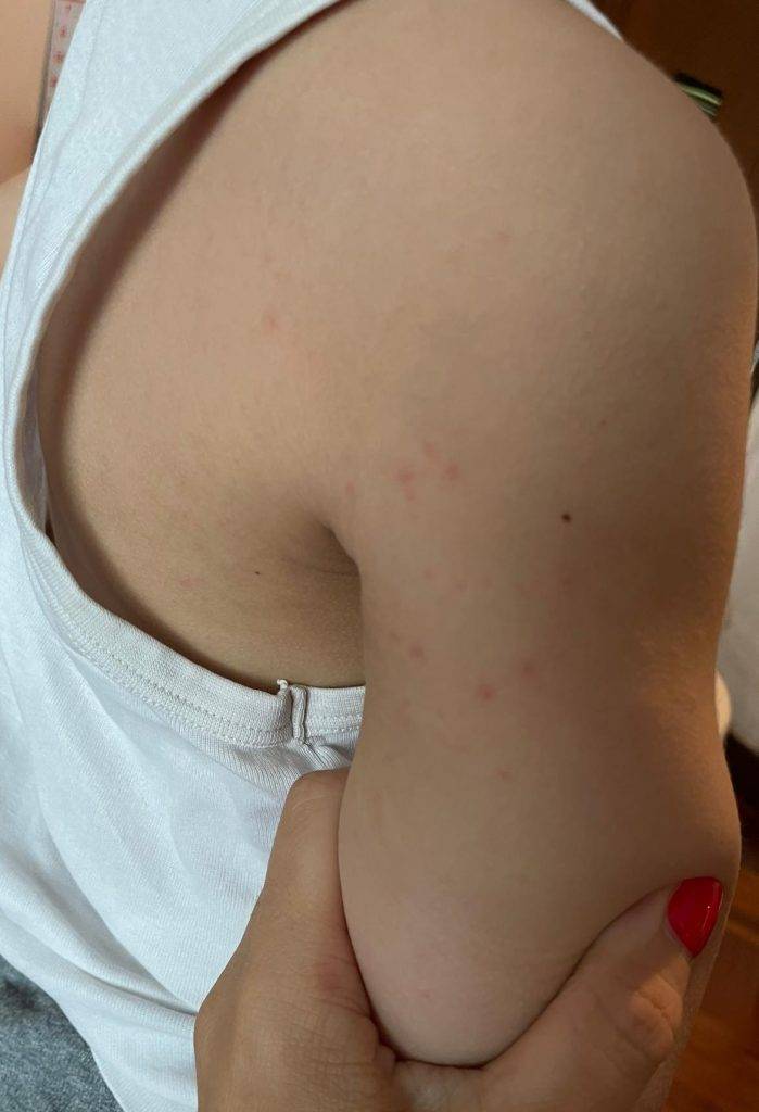 紅疹 兩位小童不約而同全身連腹、背、手、腳等都爆出有小水泡的紅疹